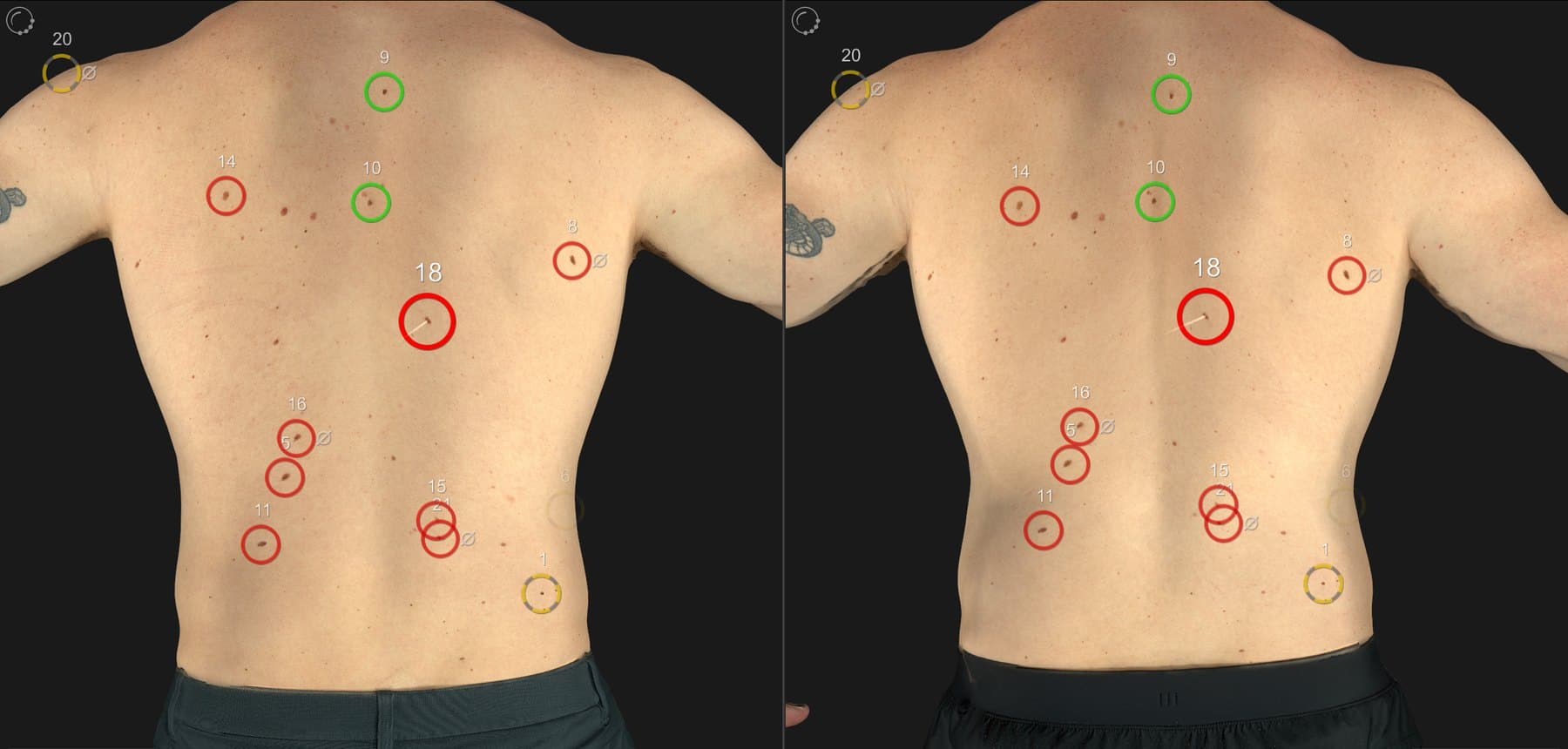 The SpotDoc comparison screen: two 3D scans of the same back, taken at baseline and six months later, with numbered spots tracked between the two visits