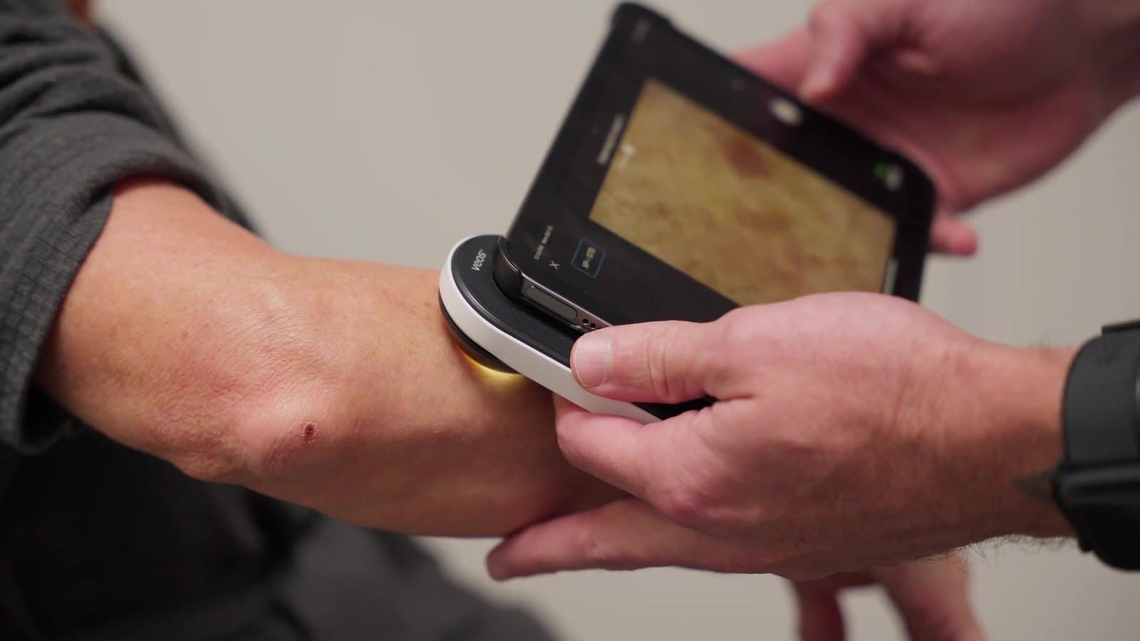 A clinician holding a dermatoscope against a patient's forearm, with the magnified view of the spot showing on the device's screen