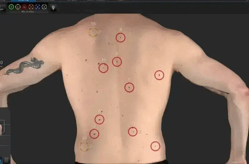 SpotCheck360 software rotating a 3D body model with numbered, color-coded markers tracking the location of individual skin spots